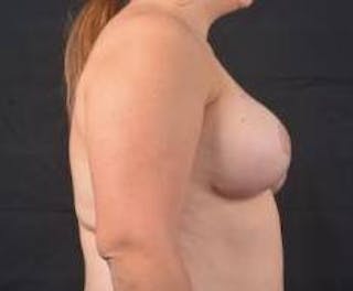 Breast Reduction Before & After Gallery - Patient 351277 - Image 6