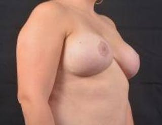 Breast Reduction Before & After Gallery - Patient 351277 - Image 10