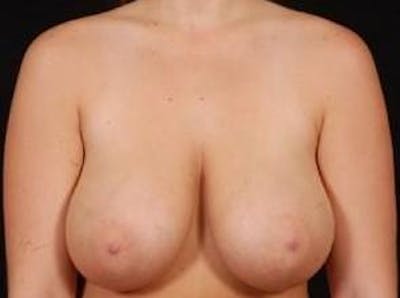 Breast Reduction Before & After Gallery - Patient 352030 - Image 1