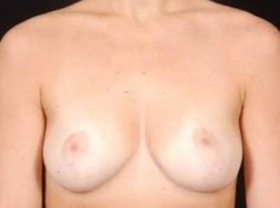 Breast Reduction Before & After Gallery - Patient 352030 - Image 2