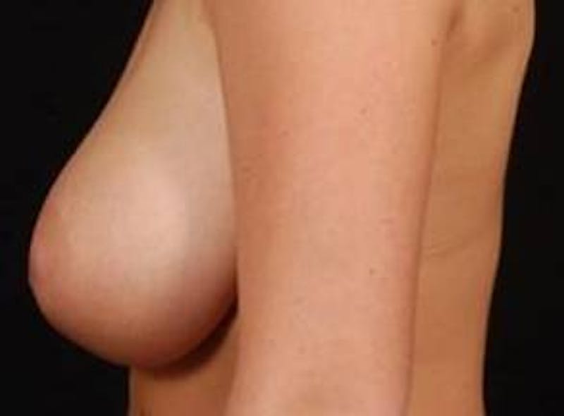 Breast Reduction Before & After Gallery - Patient 352030 - Image 3