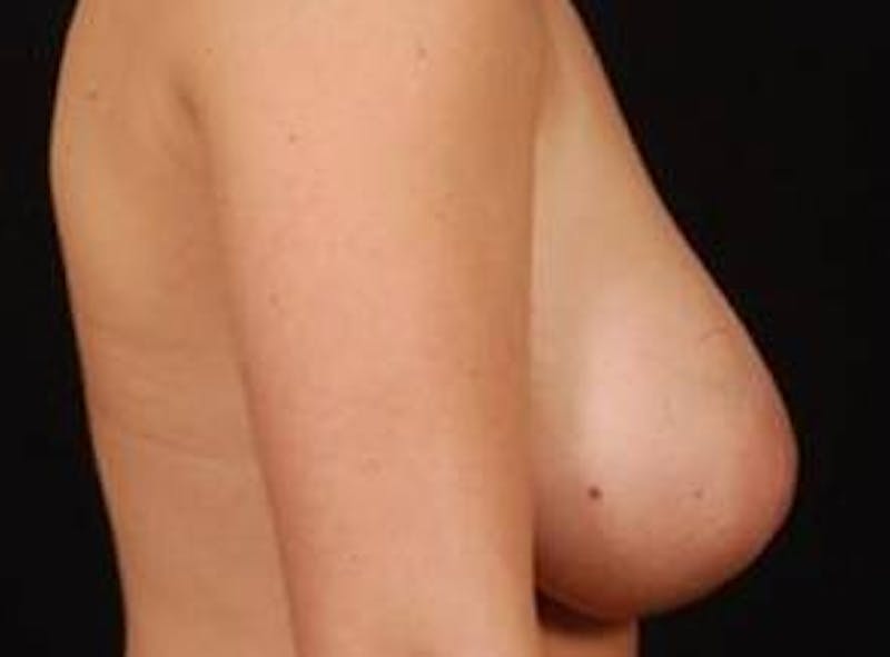 Breast Reduction Before & After Gallery - Patient 352030 - Image 5