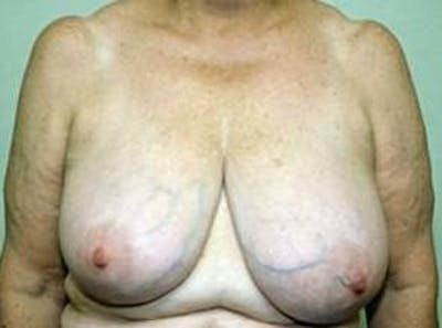 Breast Reduction Before & After Gallery - Patient 404027 - Image 1