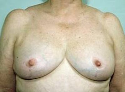 Breast Reduction Before & After Gallery - Patient 404027 - Image 2