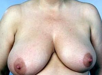 Breast Reduction Before & After Gallery - Patient 301172 - Image 1