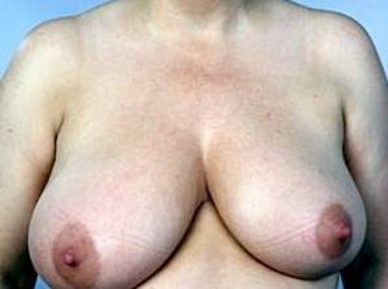 Breast Reduction Before & After Gallery - Patient 301172 - Image 1