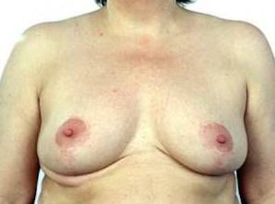 Breast Reduction Before & After Gallery - Patient 301172 - Image 2