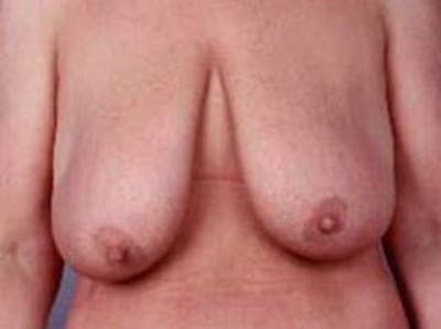 Breast Reduction Before & After Gallery - Patient 358782 - Image 1