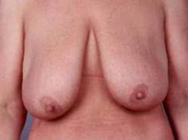 Breast Reduction Before & After Gallery - Patient 358782 - Image 1