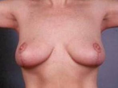 Breast Reduction Before & After Gallery - Patient 358782 - Image 2