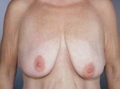 Breast Reduction Before & After Gallery - Patient 352088 - Image 1