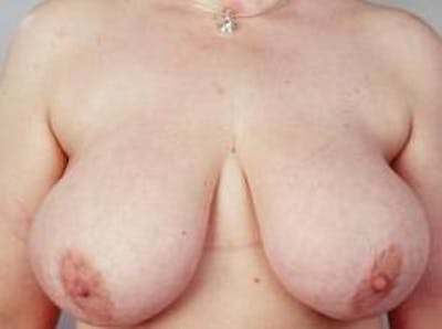 Breast Reduction Before & After Gallery - Patient 792622 - Image 1