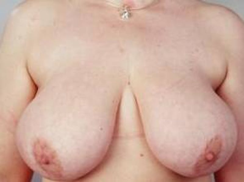 Breast Reduction Before & After Gallery - Patient 792622 - Image 1