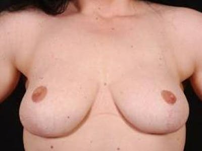 Breast Reduction Before & After Gallery - Patient 792622 - Image 2