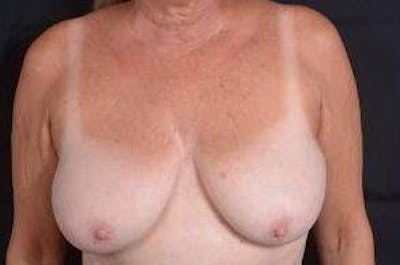 Breast Reduction Before & After Gallery - Patient 189245 - Image 1
