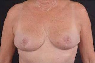 Breast Reduction Before & After Gallery - Patient 189245 - Image 2