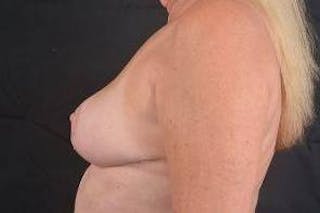 Breast Reduction Before & After Gallery - Patient 189245 - Image 4