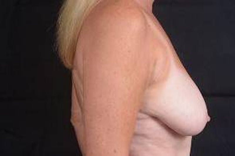 Breast Reduction Before & After Gallery - Patient 189245 - Image 5