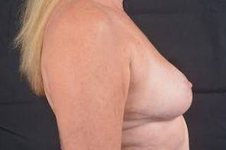 Breast Reduction Before & After Gallery - Patient 189245 - Image 6