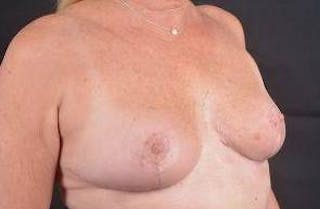 Breast Reduction Before & After Gallery - Patient 189245 - Image 10