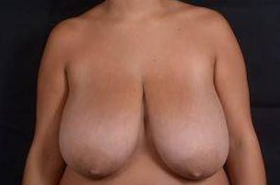 Breast Reduction Before & After Gallery - Patient 242546 - Image 1