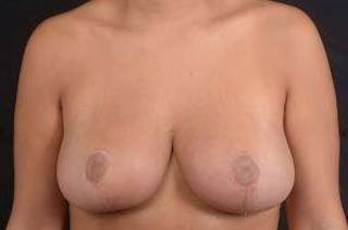 Breast Reduction Before & After Gallery - Patient 242546 - Image 2