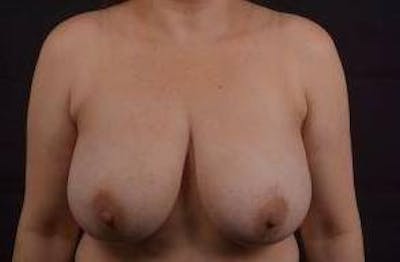 Breast Reduction Before & After Gallery - Patient 228895 - Image 1