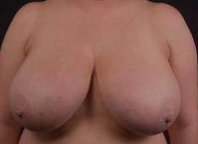 Breast Reduction Before & After Gallery - Patient 399763 - Image 1