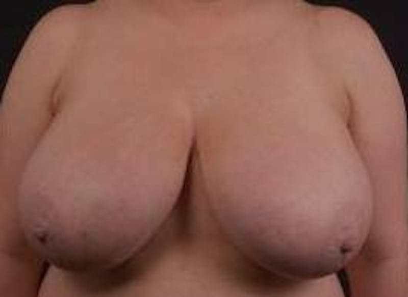 Breast Reduction Before & After Gallery - Patient 399763 - Image 1