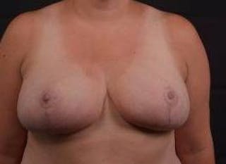 Breast Reduction Before & After Gallery - Patient 399763 - Image 2