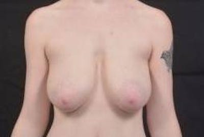 Breast Reduction Before & After Gallery - Patient 230682 - Image 1