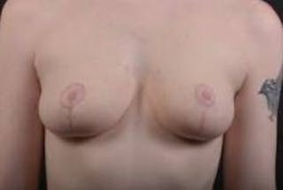 Breast Reduction Before & After Gallery - Patient 230682 - Image 2