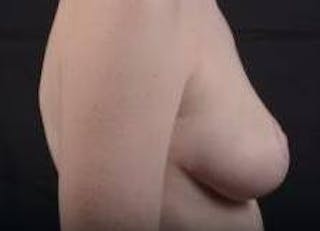 Breast Reduction Before & After Gallery - Patient 230682 - Image 6