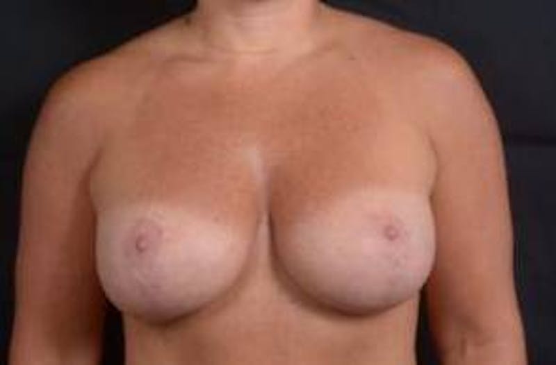 Mastopexy Before & After Gallery - Patient 993410 - Image 2