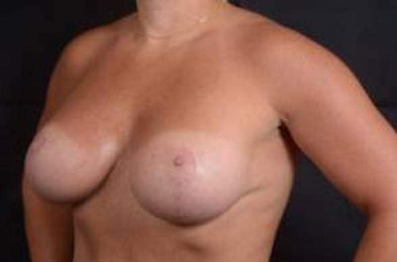 Mastopexy Before & After Gallery - Patient 993410 - Image 8