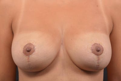 Mastopexy Before & After Gallery - Patient 386362 - Image 2