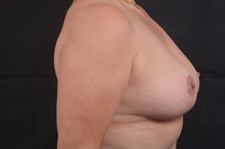 Mastopexy Before & After Gallery - Patient 113720 - Image 6