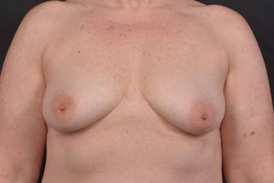 Mastopexy Before & After Gallery - Patient 423216 - Image 1