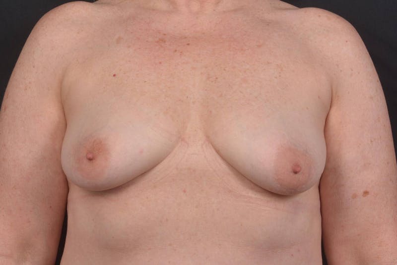 Mastopexy Before & After Gallery - Patient 423216 - Image 1