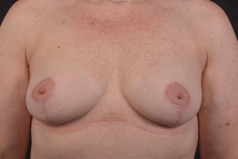 Mastopexy Before & After Gallery - Patient 423216 - Image 2