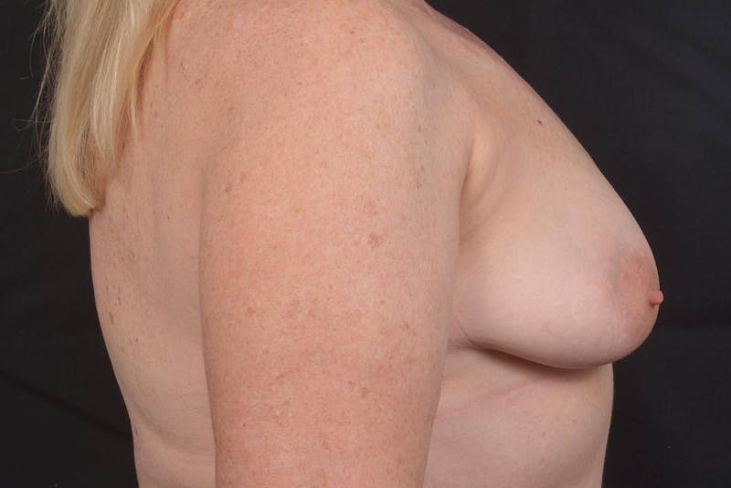 Mastopexy Before & After Gallery - Patient 423216 - Image 5