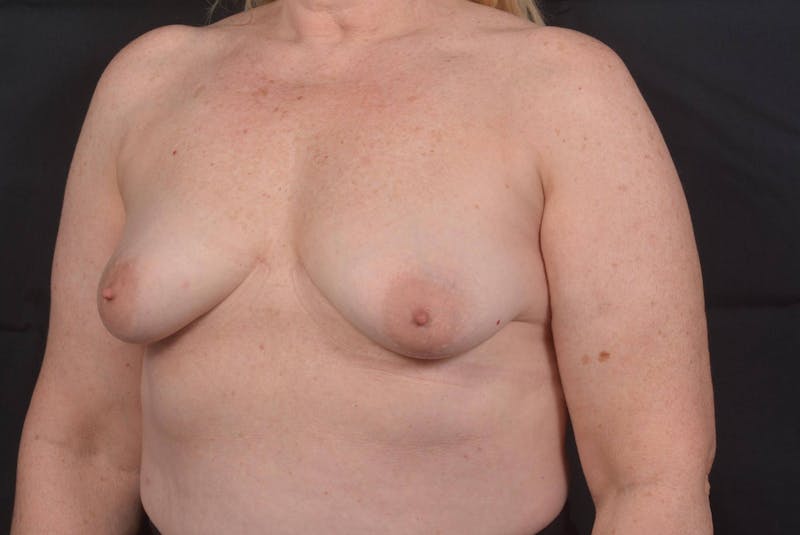Mastopexy Before & After Gallery - Patient 423216 - Image 7
