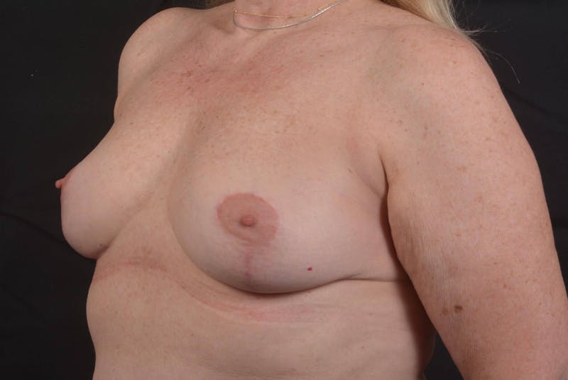 Mastopexy Before & After Gallery - Patient 423216 - Image 8