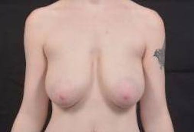 Mastopexy Before & After Gallery - Patient 656836 - Image 1
