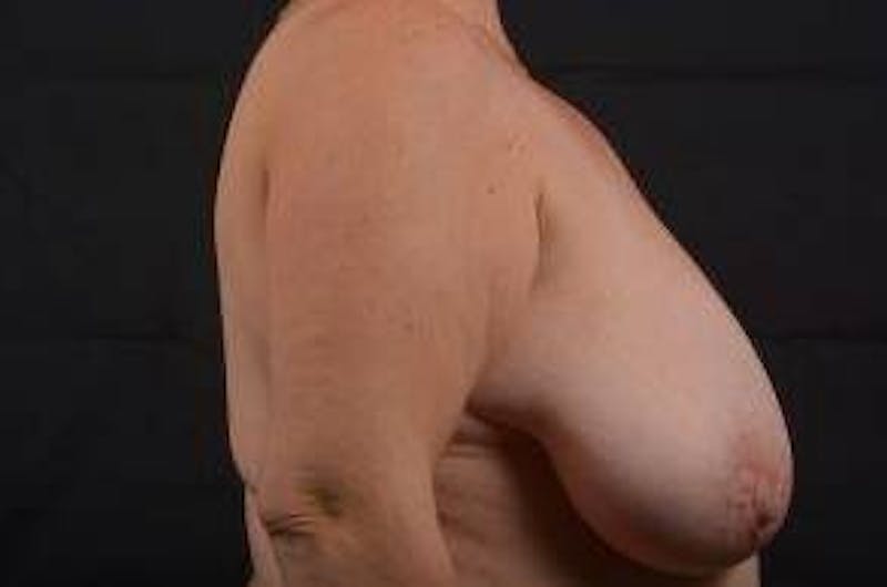 Mastopexy Before & After Gallery - Patient 601059 - Image 5