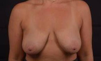 Mastopexy Before & After Gallery - Patient 288121 - Image 1