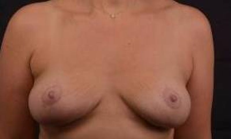 Mastopexy Before & After Gallery - Patient 288121 - Image 2