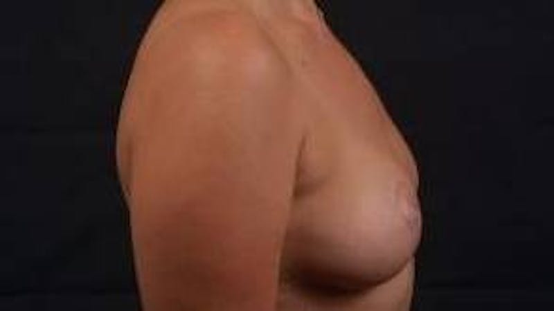 Mastopexy Before & After Gallery - Patient 288121 - Image 6