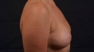 Mastopexy Before & After Gallery - Patient 288121 - Image 6