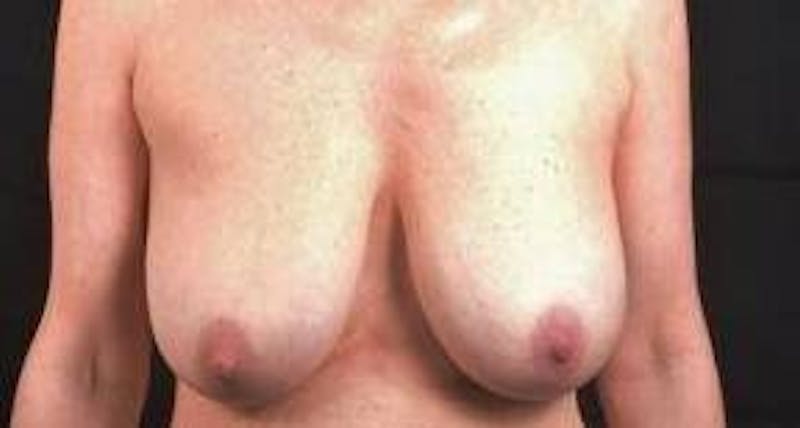 Mastopexy Before & After Gallery - Patient 159407 - Image 1